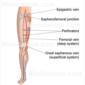 Varicose Vein Ligation - Varicose Veins More That A Cosmetic Concern