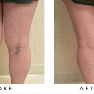 Varicose Veins Recovery - Natural Supplements And Vitamins For Varicose Veins