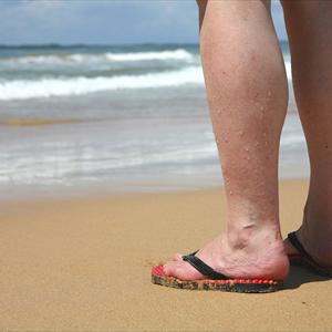 Evaluation Varicose - What Are Varicose Veins