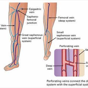 Varicose - 8 Ways To Treat Varicose Veins With Non-Medical Methods