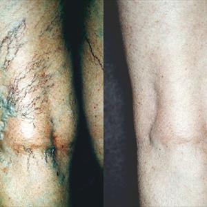 Vein Treatment Center - Understanding Varicose Veins