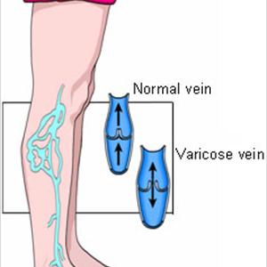 Vericose Veins Orange - Skin Care- What Is Stasis Eczema?