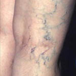 Varicosity Definition - A Review Of Laser Treatment For Varicose Veins